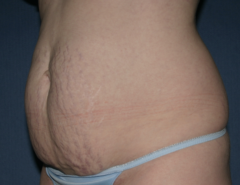 Power Assisted Liposuction Before & After Patient #3028