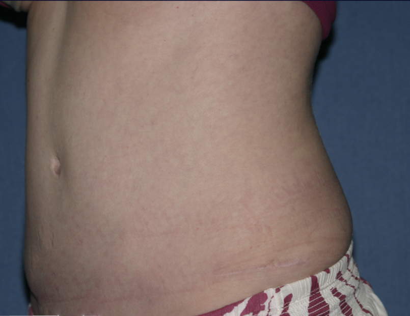 Power Assisted Liposuction Before & After Patient #3028