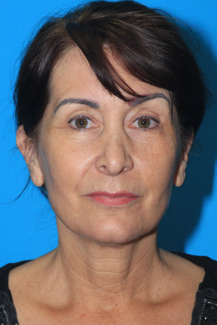 Rhinoplasty Before & After Patient #3136