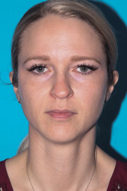 Rhinoplasty Before & After Patient #3197
