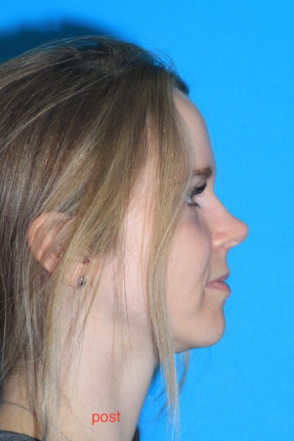 Rhinoplasty Before & After Patient #3197