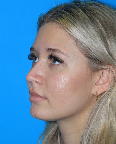 Rhinoplasty Before & After Patient #3154