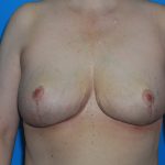 Internal Mastopexy (Breast Lift) with Implant Removal Before & After Patient #3208