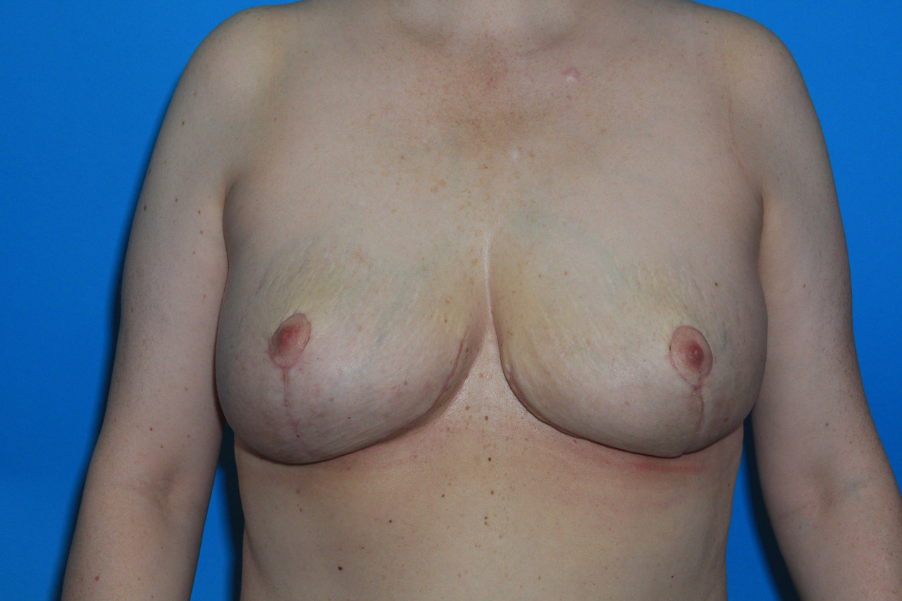 Internal Mastopexy (Breast Lift) with Implant Removal Before & After Patient #3208