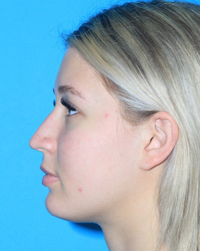 Rhinoplasty Before & After Patient #3154
