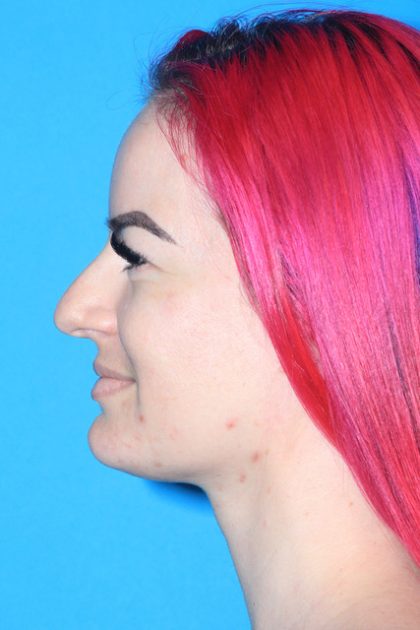 Rhinoplasty Before & After Patient #3131