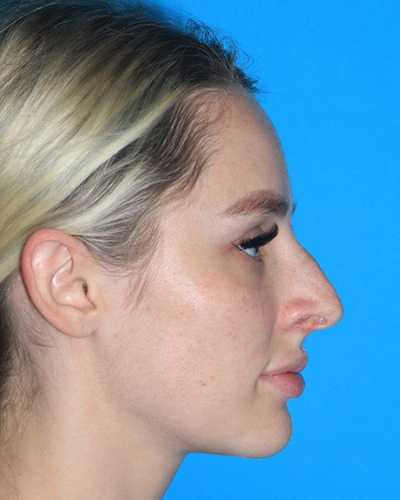 Rhinoplasty Before & After Patient #3161