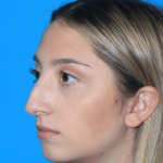 Rhinoplasty Before & After Patient #3215