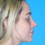 Rhinoplasty Before & After Patient #3161