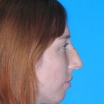 Rhinoplasty Before & After Patient #3168