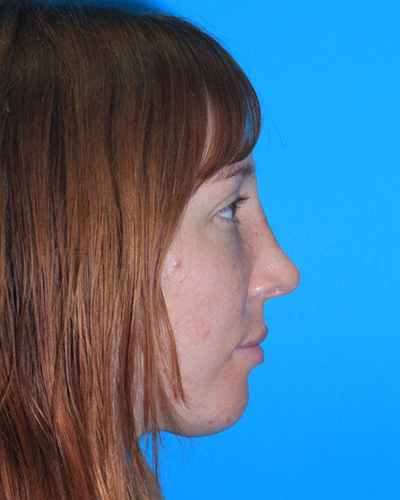 Rhinoplasty Before & After Patient #3168