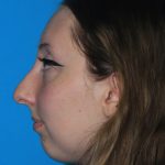Rhinoplasty Before & After Patient #3175