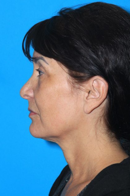 Rhinoplasty Before & After Patient #3136