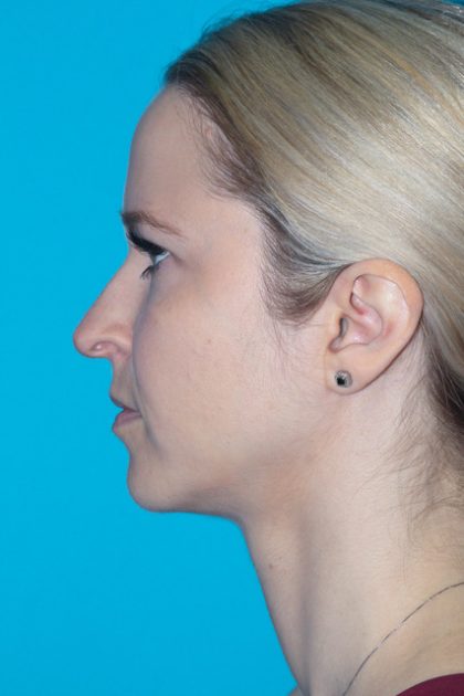 Rhinoplasty Before & After Patient #3197