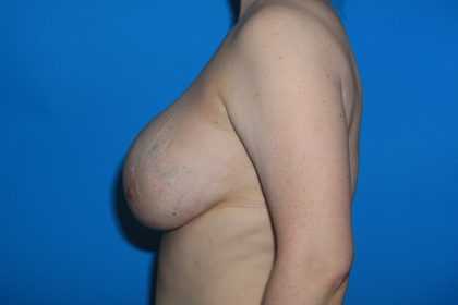 Internal Mastopexy (Breast Lift) with Implant Removal Before & After Patient #3208