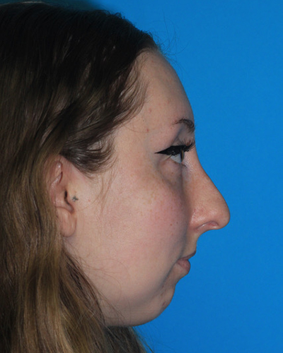 Rhinoplasty Before & After Patient #3175