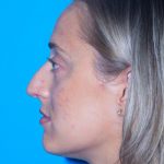 Rhinoplasty Before & After Patient #3186
