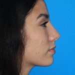 Rhinoplasty Before & After Patient #3124