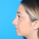 Rhinoplasty Before & After Patient #3215