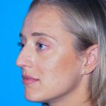 Rhinoplasty Before & After Patient #3186