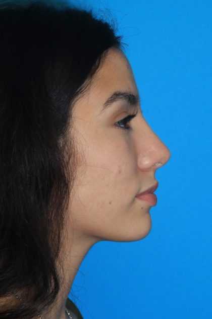Rhinoplasty Before & After Patient #3124