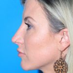 Rhinoplasty Before & After Patient #3359