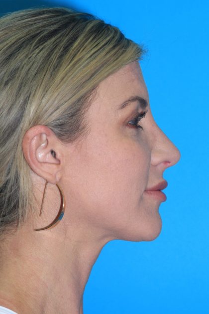 Rhinoplasty Before & After Patient #3359