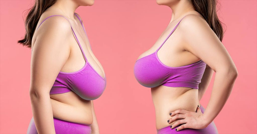 Woman shown before and after with her breasts lifted.  Dr. Wolin Plastic Surgery Center.